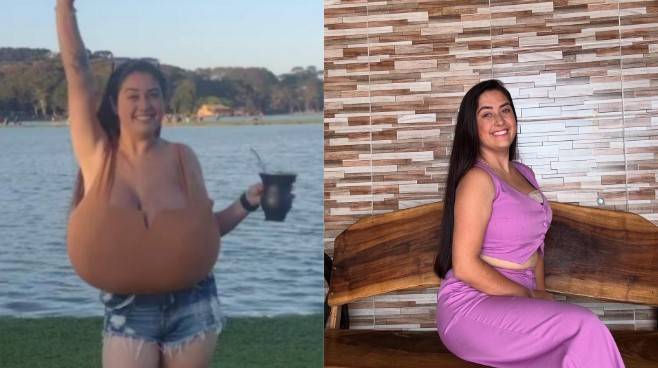 Jovem do Paraná retira 10 kg de mama após diagnóstico de doença rara