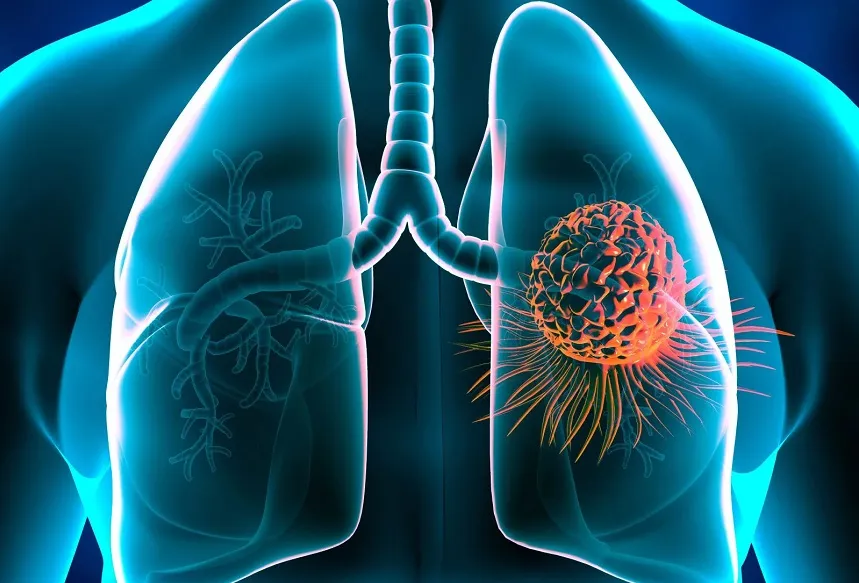 Câncer de pulmão: doença ‘se alimenta’ de um ingrediente popular que muitos consomem; saiba qual é