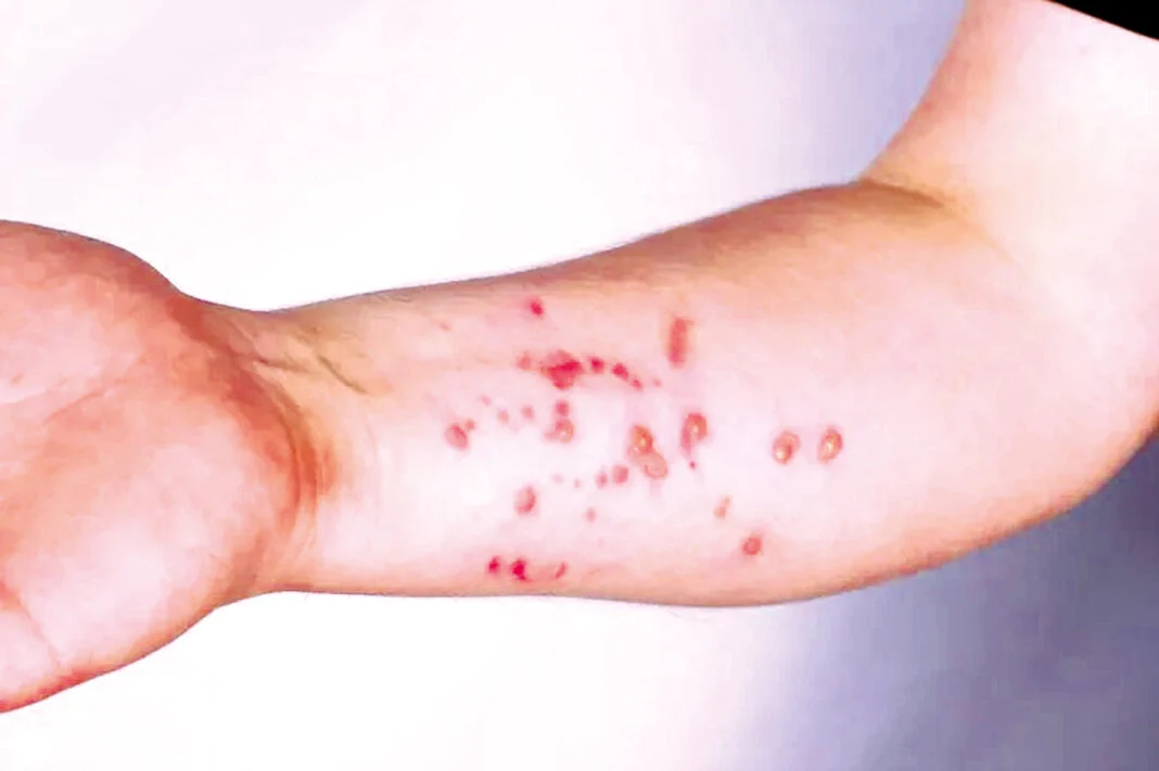 Secretaria de Saúde descarta caso de monkeypox em paciente potiguar