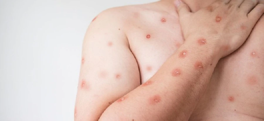 Sobe para 140 número de casos confirmados de Mpox no país, em 2026